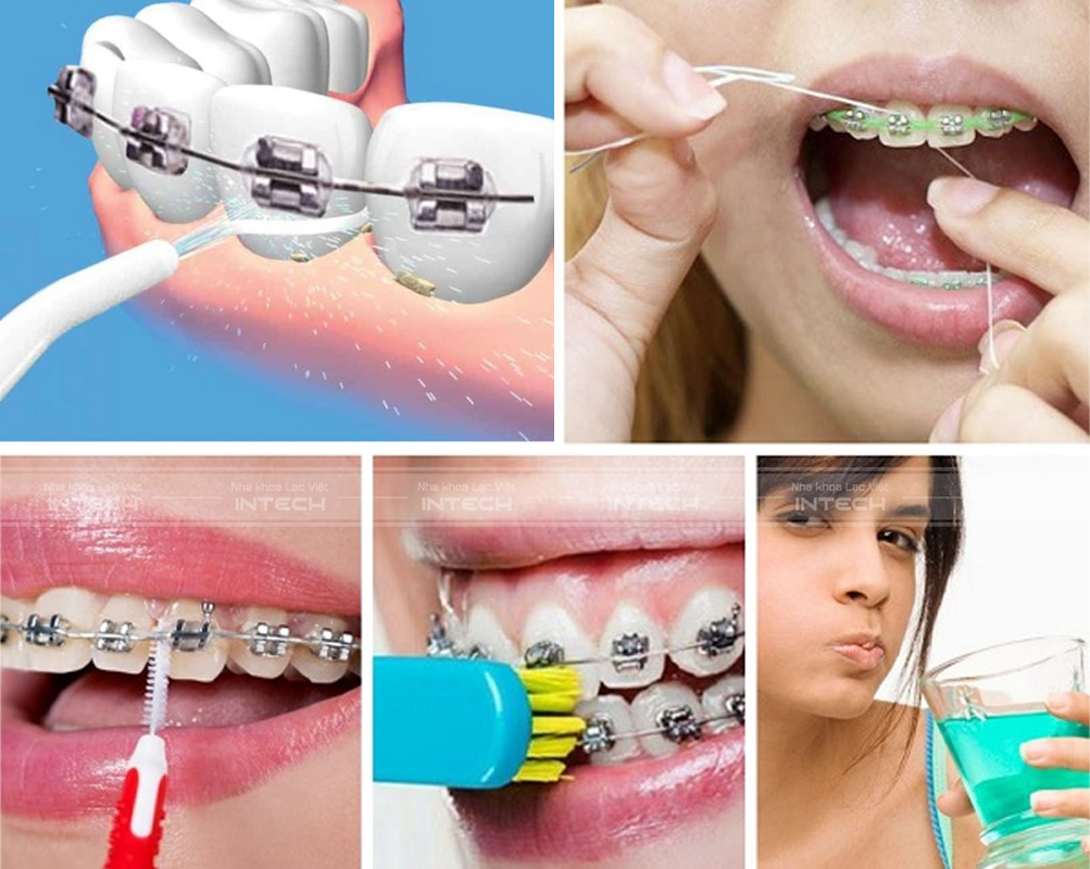 Vệ sinh răng miệng sạch sẽ giúp quá trình niềng răng diễn ra thuận lợi