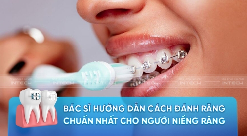 Cách đánh răng chuẩn nhất khi niềng răng - Bạn đã biết chưa?