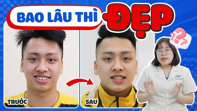 Niềng răng mất bao lâu? 3 cách rút ngắn thời gian an toàn, hiệu quả