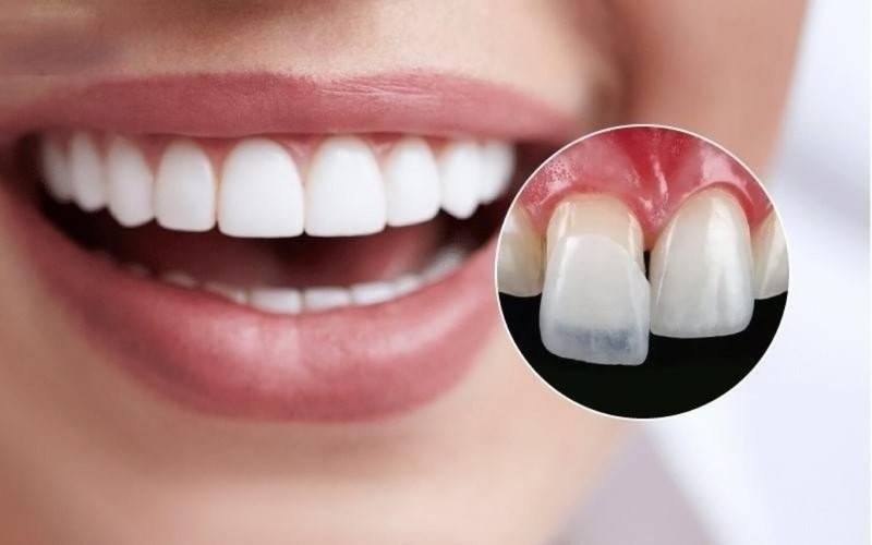 dán sứ thay đổi tướng răng