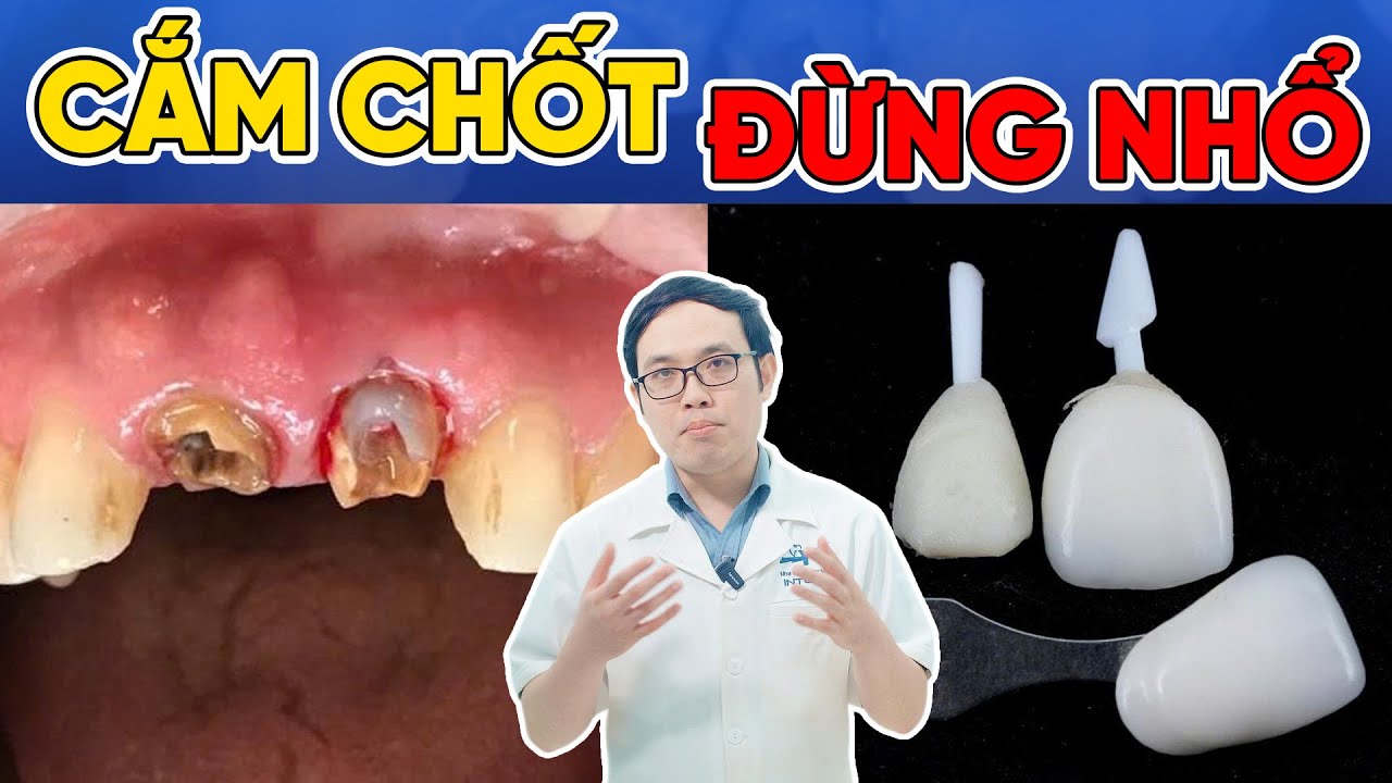 Cắm Chốt Răng: Giải Pháp Giữ Lại Răng Gãy, Vỡ Tưởng Phải Nhổ Bỏ