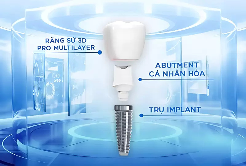 Phục hình bằng công nghệ DCT đảm bảo thẩm mỹ đẹp, ăn nhai tốt