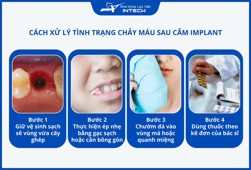 Chảy máu nhẹ sau cắm Implant là biểu hiện bình thường và có thể xử lý tại nhà, tuy nhiên nếu có các dấu hiệu bất thường thì cần nhanh chóng tái khám