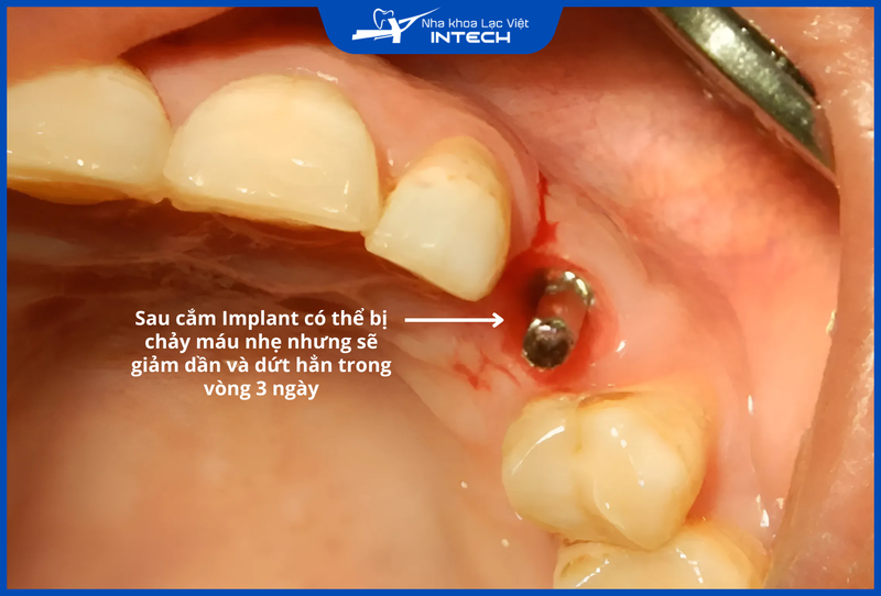 Hiện tượng chảy máu do cơ thể phản ứng tự nhiên với vật lạ sẽ giảm dần và dứt hẳn trong vòng 3 ngày đầu sau cấy ghép