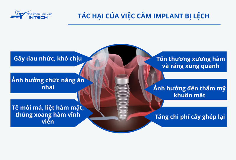 Cắm Implant bị lệch dẫn đến nhiều tác hại và biến chứng nghiêm trọng không thể phục hồi