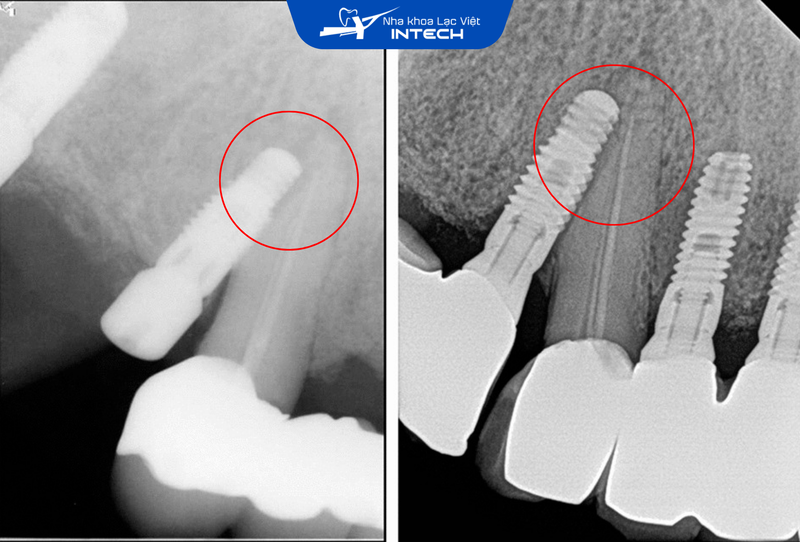 2 lý do cắm Implant bị lệch cần lưu tâm, tránh hậu quả khôn lường