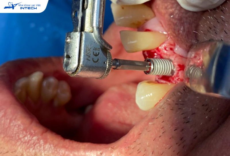 Rủi ro đào thải khi cắm Implant bị viêm nếu không điều trị kịp thời