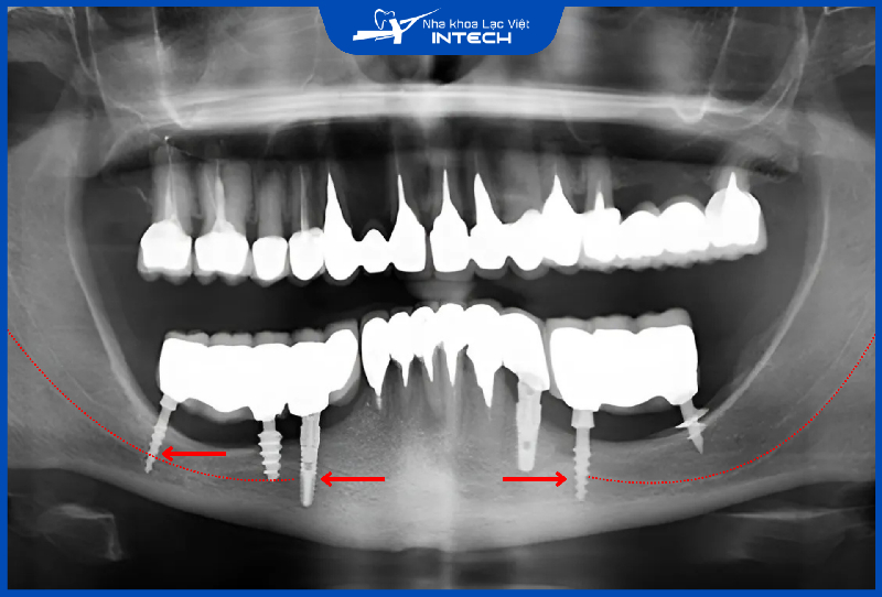 Nếu bác sĩ cắm Implant chạm vào ống thần kinh hàm dưới có thể gây tê bì, đau nhức hoặc mất cảm giác tạm thời, vĩnh viễn