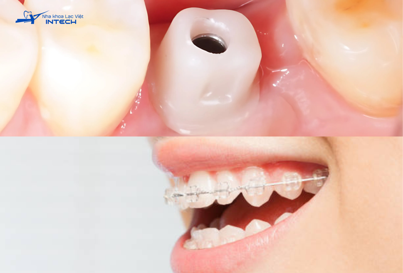 Có thể niềng răng sau khi cắm Implant nhưng tùy thuộc vào từng trường hợp khác nhau