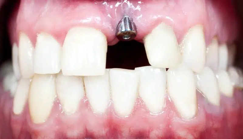 Hình ảnh các trụ Implant đặt sai vị trí (Nguồn: Avant Dental) 