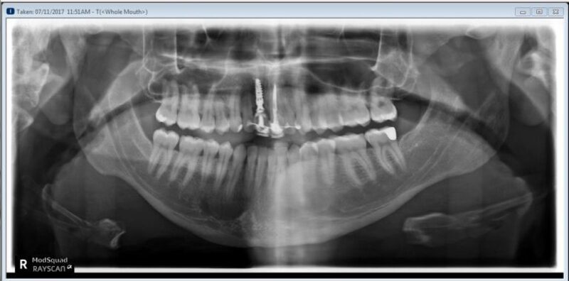 Hình ảnh trụ Implant được đặt ở vị trí răng phía trước (Nguồn: MOD Squad Dental) 