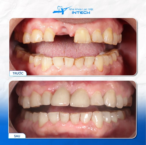 Giá trồng Implant đơn lẻ tại Nha khoa Lạc Việt Intech đã bao gồm mão răng sứ và trụ phục hình cá nhân hóa