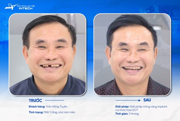 Trồng răng Implant đơn lẻ áp dụng cho các cô chú/anh chị mất một hoặc một số răng ở vị trí khác nhau