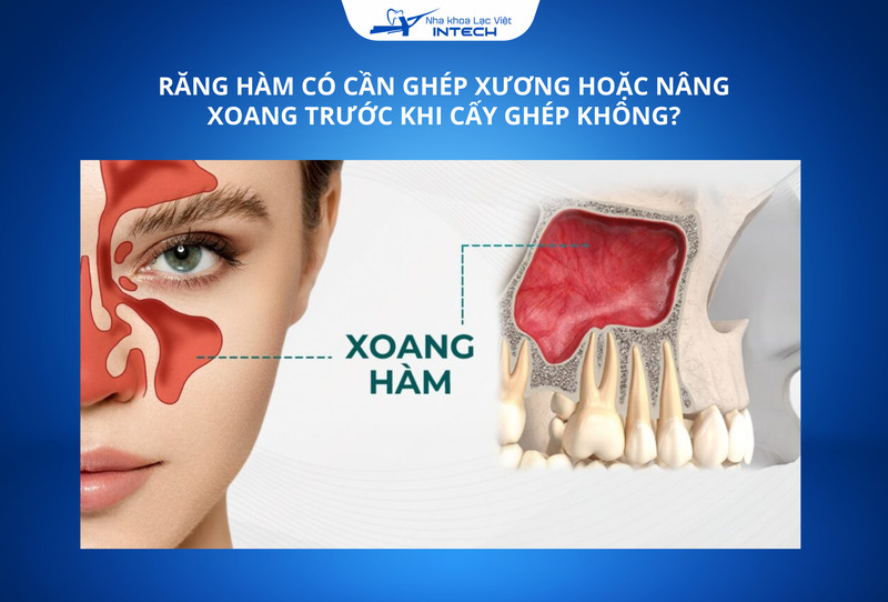 Bác sĩ sẽ chỉ định nâng xoang để tạo đủ không gian cấy ghép trong trường hợp xương không đủ chiều cao để đặt trụ