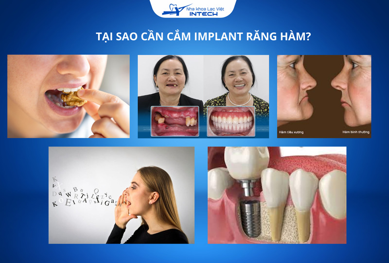 Cắm Implant răng hàm là giải pháp tối ưu giúp đảm bảo ăn nhai, ngăn ngừa ảnh hưởng thẩm mỹ gương mặt, bảo vệ răng lân cận