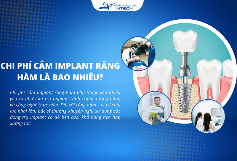 Chi phí cắm Implant răng hàm phụ thuộc vào các yếu tố như loại trụ Implant, tình trạng xương hàm và công nghệ thực hiện