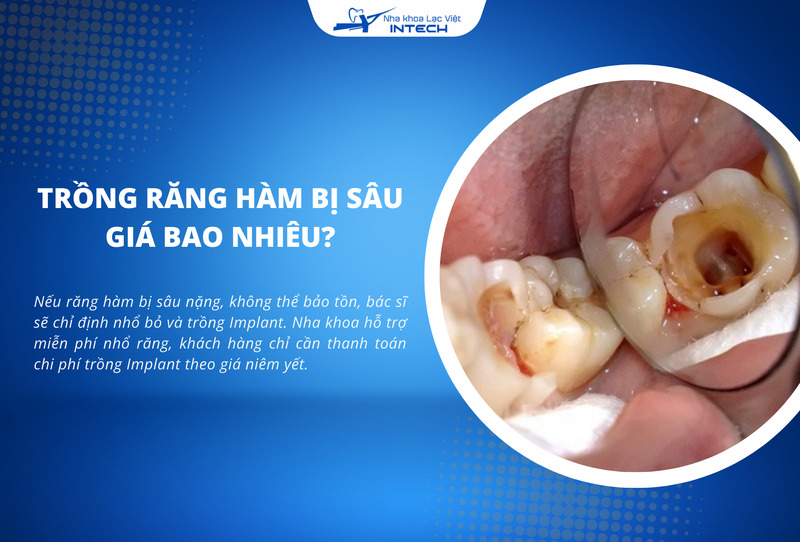 Nha khoa hỗ trợ miễn phí nhổ răng khi cô chú/anh chị thực hiện cấy ghép Implant, chỉ cần thanh toán chi phí trồng Implant theo giá niêm yết