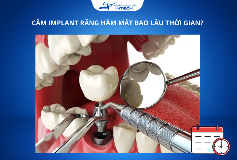 Tổng hợp 6 câu hỏi về cắm Implant răng hàm