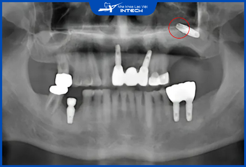 Nếu cắm Implant sai lệch gây thủng xương hàm có thể gây viêm xoang mãn tính, đồng thời đào thải trụ Implant