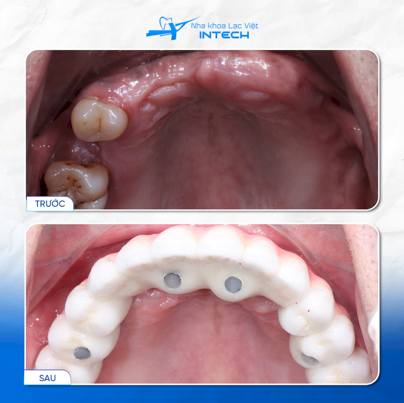 Cắm vít Implant có độ chính xác cao hơn, dễ dàng sửa chữa, hạn chế được nguy cơ viêm nhiễm nướu