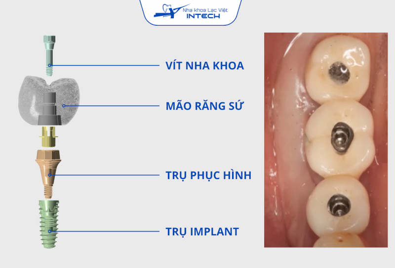 Cắm vít Implant là gì? Phân biệt với cắm Minivis và bắt vít mão sứ