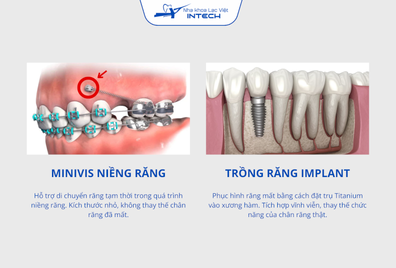 Minivis niềng răng cắm tạm thời vào xương hàm để điều chỉnh hướng răng, trong khi Implant cắm vĩnh viễn để thay thế chân răng đã mất