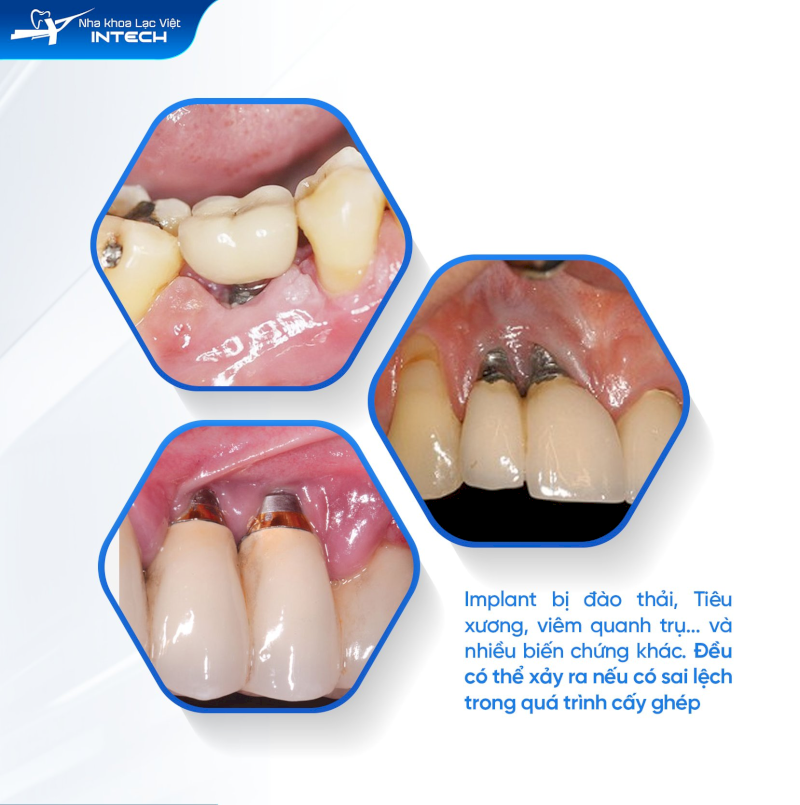 Trồng Implant giá rẻ hoặc thực hiện bởi bác sĩ thiếu chuyên môn có thể mắc các biến chứng hậu phẫu