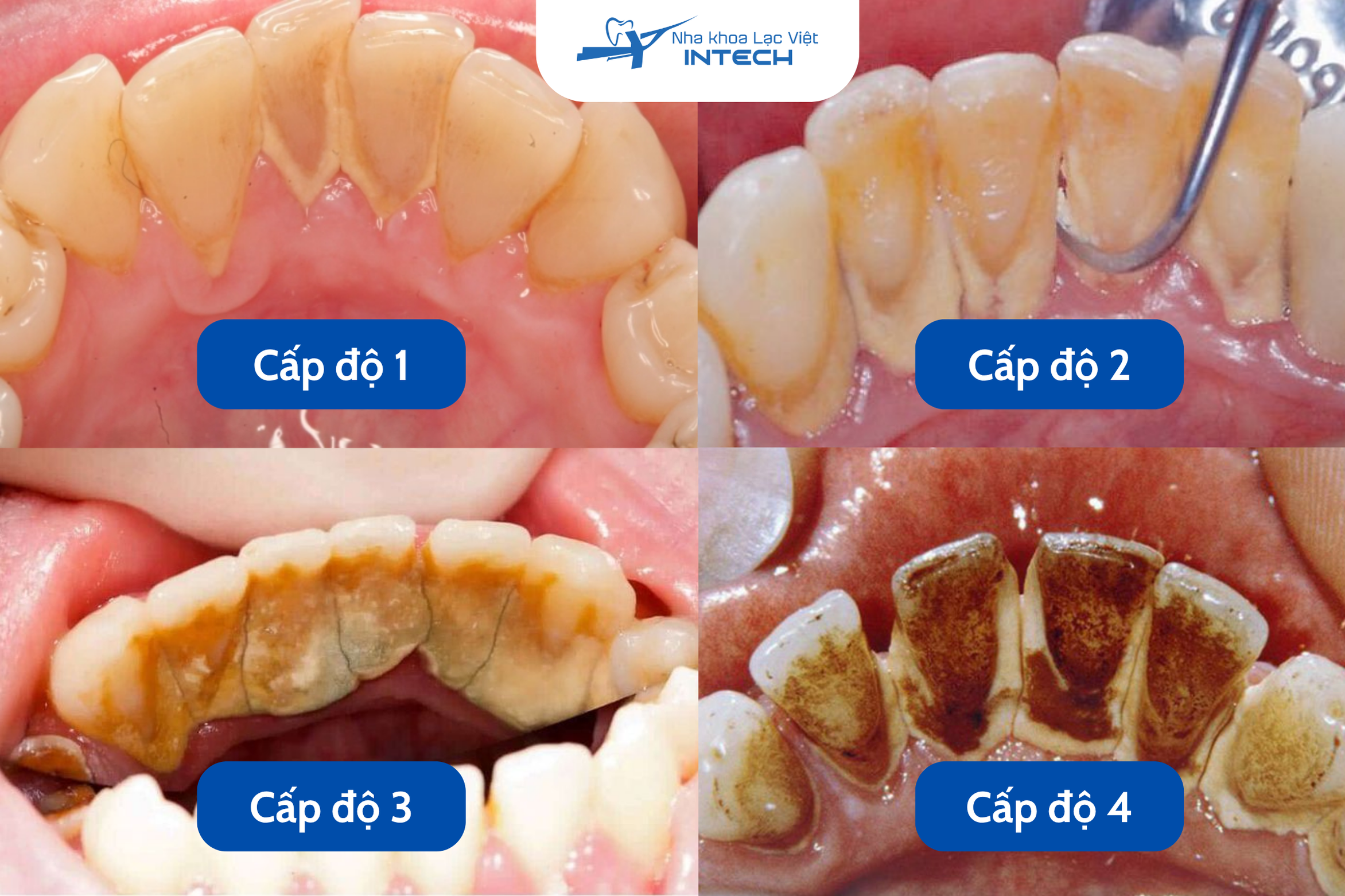 Các cấp độ của cao răng