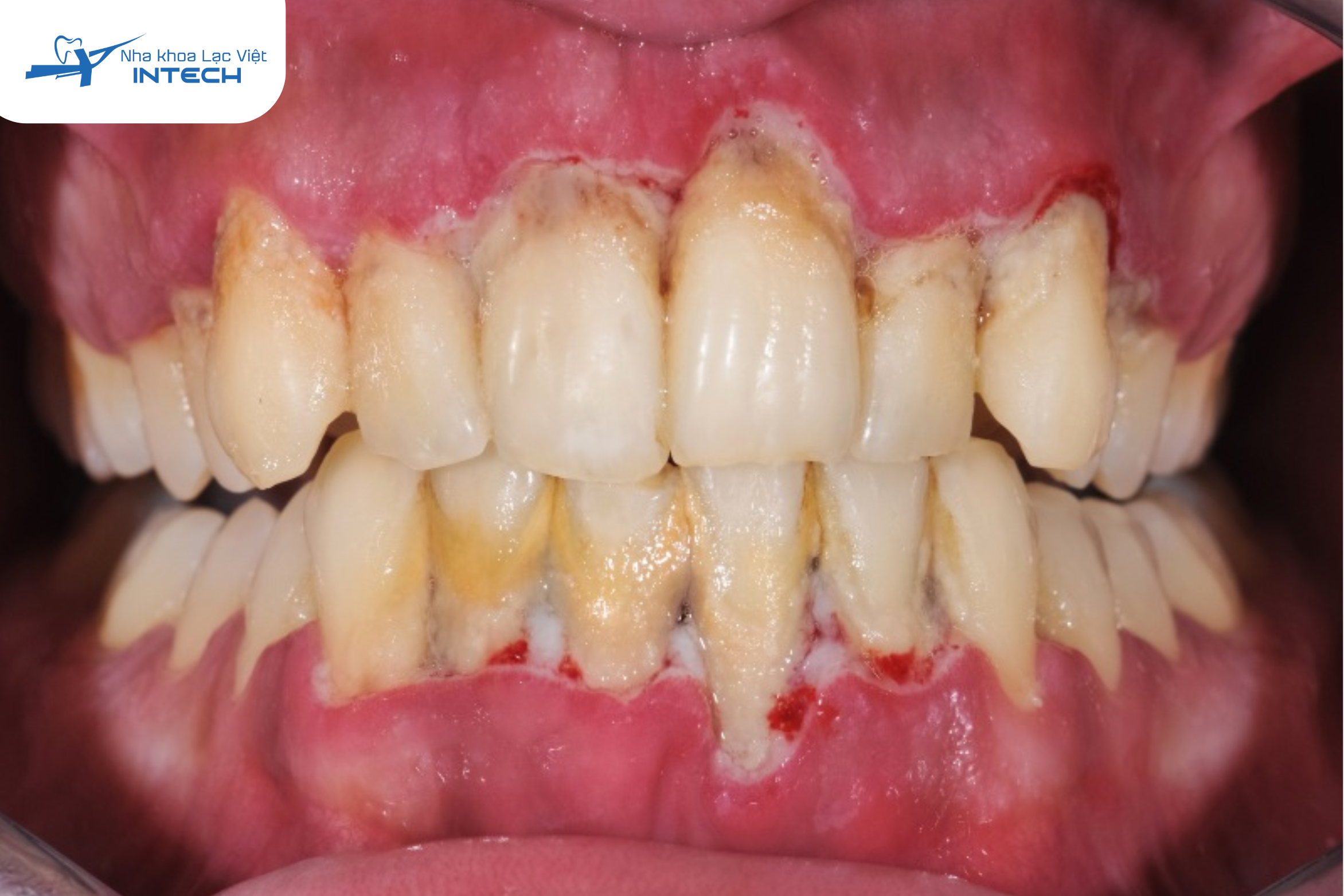 Vi khuẩn trong cao răng gây kích ứng, làm nướu sưng, đỏ và dễ chảy máu tạo thành viêm lợi, nặng hơn là viêm nha chu