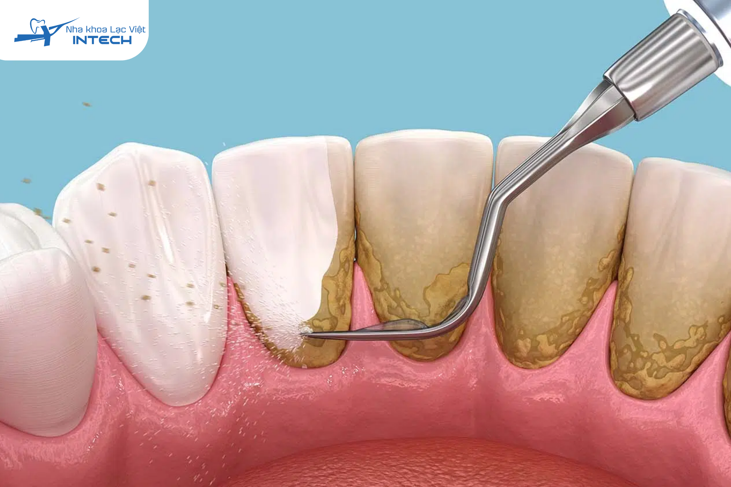 Cao răng (hay còn gọi là vôi răng) là những mảng bám đã bị vôi hóa, tích tụ lâu ngày trên bề mặt răng và dưới nướu