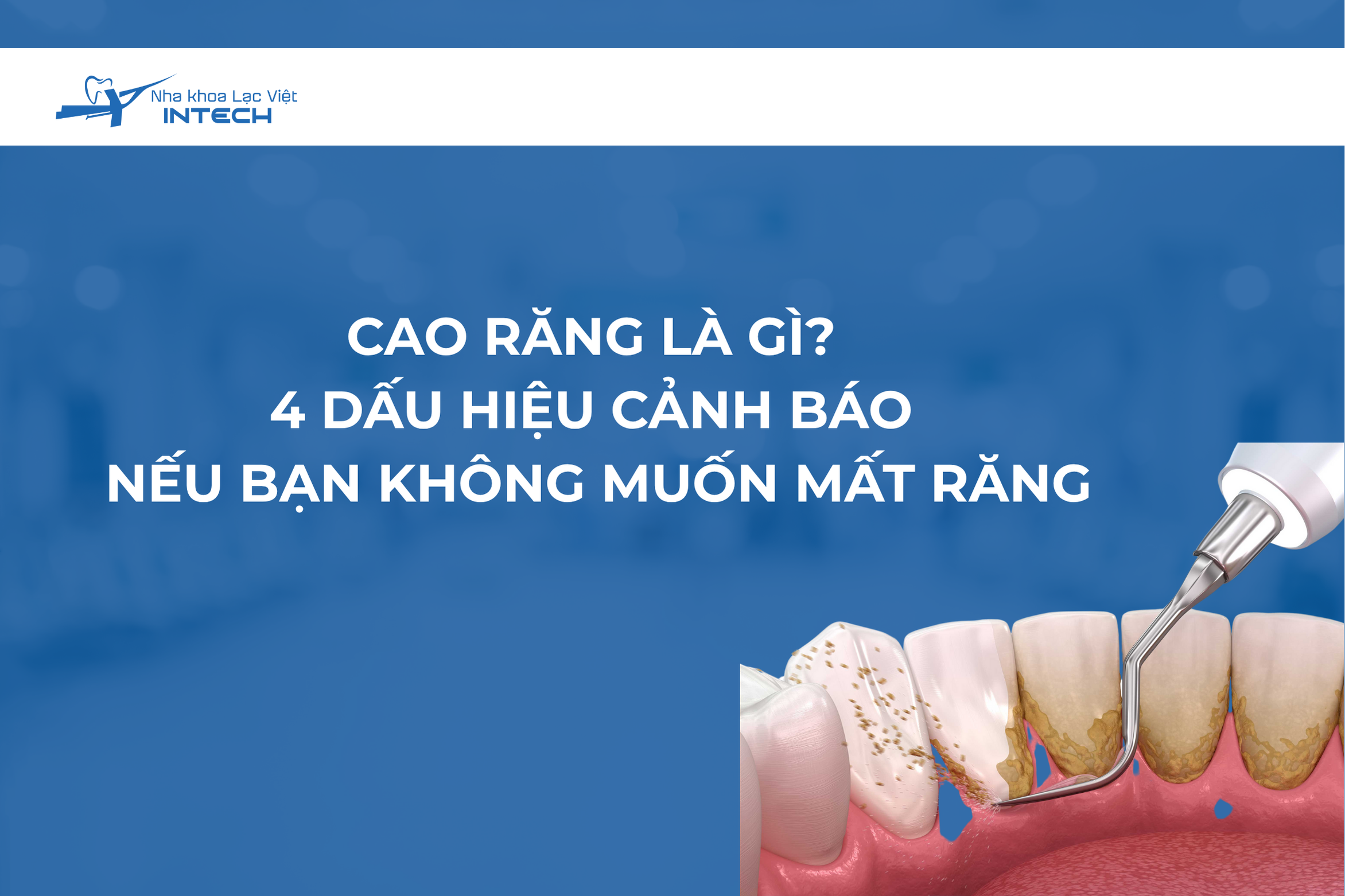 Cao răng là gì? 4 dấu hiệu cảnh báo nếu bạn không muốn mất răng
