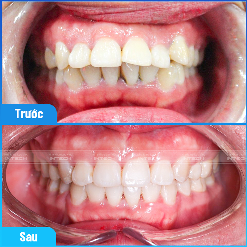 Tình trạng răng ban đầu và sau khi điều trị niềng răng bằng công nghệ X-Matrix tại Nha khoa Lạc Việt Intech