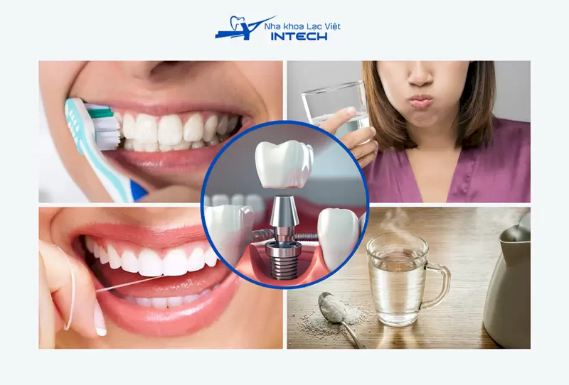 Bản chất Implant không gây hôi miệng, hôi miệng là tình trạng ứ đọng thức ăn do không vệ sinh kỹ gây ra