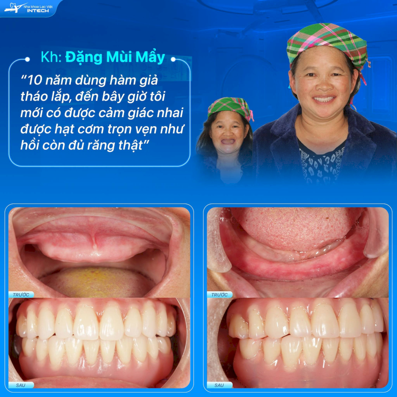 Cấy ghép Implant là phương pháp khôi phục chức năng ăn nhai tốt nhất hiện nay