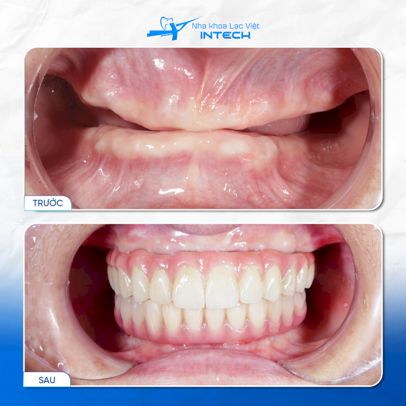 Đối với trường hợp mất nhiều răng hoặc mất toàn hàm, bác sĩ có thể chỉ định phương pháp All-On-4, All-On-6