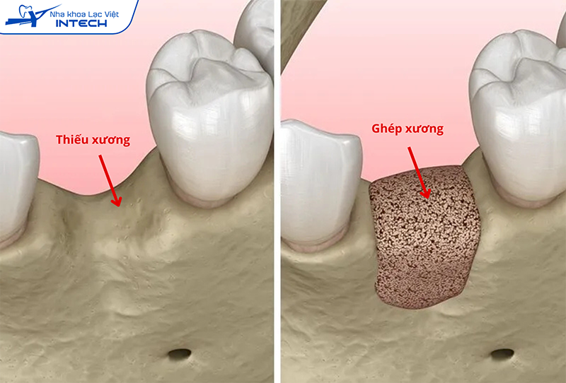 Ghép xương là thủ thuật hỗ trợ trước khi cắm Implant với những tình trạng bị tiêu xương