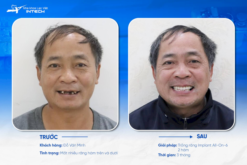 Implant đạt chuẩn có thể tồn tại lên tới 20 - 30 năm, thậm chí trọn đời nếu được chăm sóc tốt