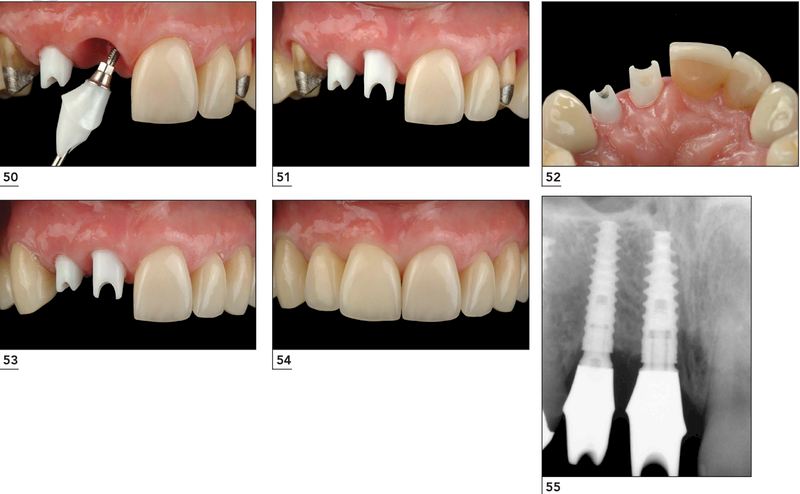 Mão răng sứ thường được lắp khi trụ Implant đã hoàn toàn tích hợp với xương hàm và nướu đã lành thương