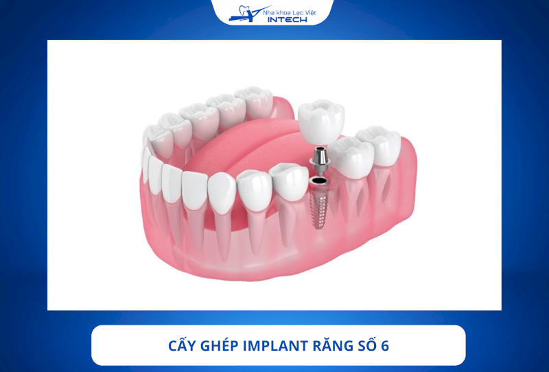 Mất răng số 6 lâu năm vẫn có thể phục hình bằng cấy ghép Implant