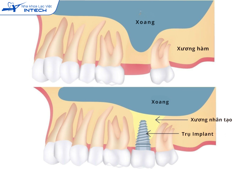 Nâng xoang áp dụng khi cấy ghép Implant hàm trên, áp dụng với những trường hợp xoang hàm bị hạ thấp