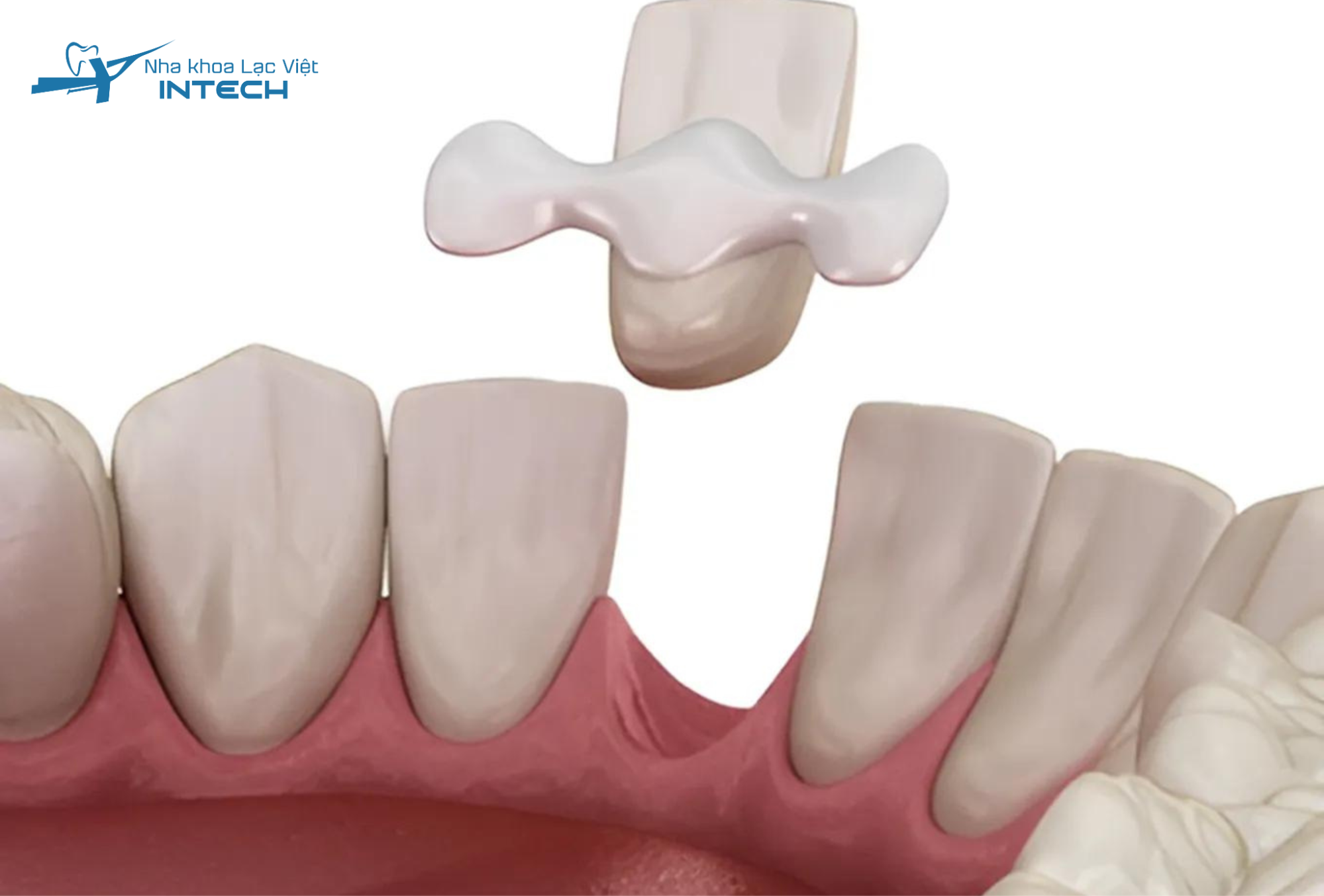 Cầu răng cánh dán mang lại thẩm mỹ ổn định tuy nhiên phương pháp này có độ bền không cao.