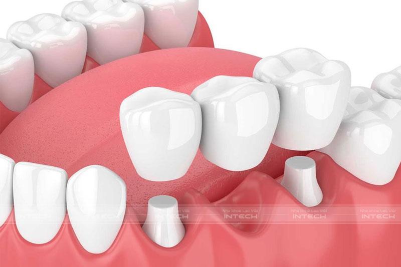 Phương pháp cầu răng sứ truyền thống phải mài 2 chiếc răng bên cạnh