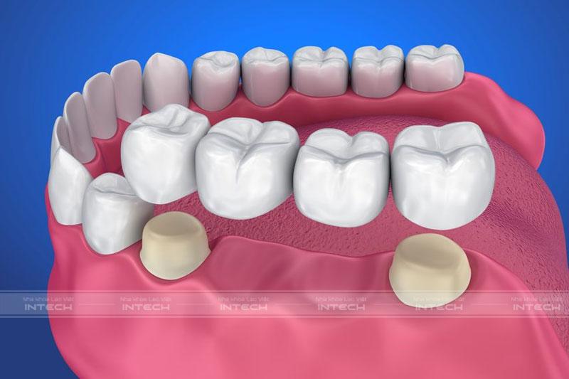 Cầu răng sứ bao gồm 2 mão răng bên phía ngoài cùng và răng sứ ở giữa có khả năng thay thế răng mất