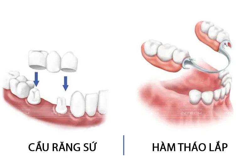 Phương pháp cầu răng sứ và hàm tháo lắp lâu ngày sẽ gây tiêu xương hàm