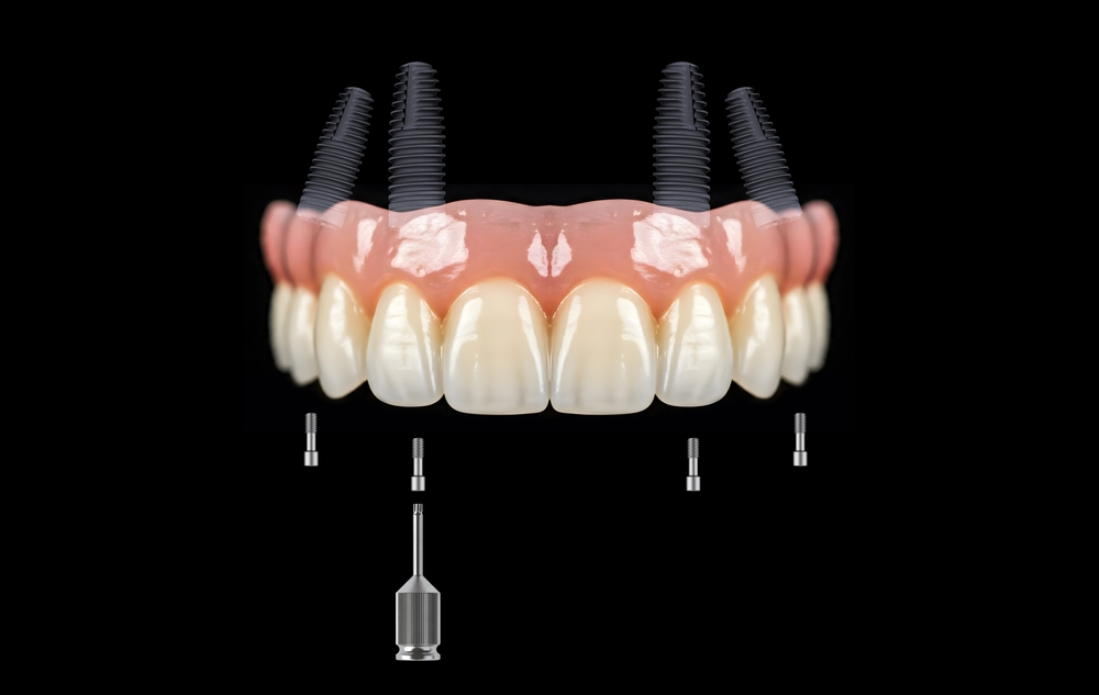 Implant toàn hàm có cấu tạo gồm 3 phần chính