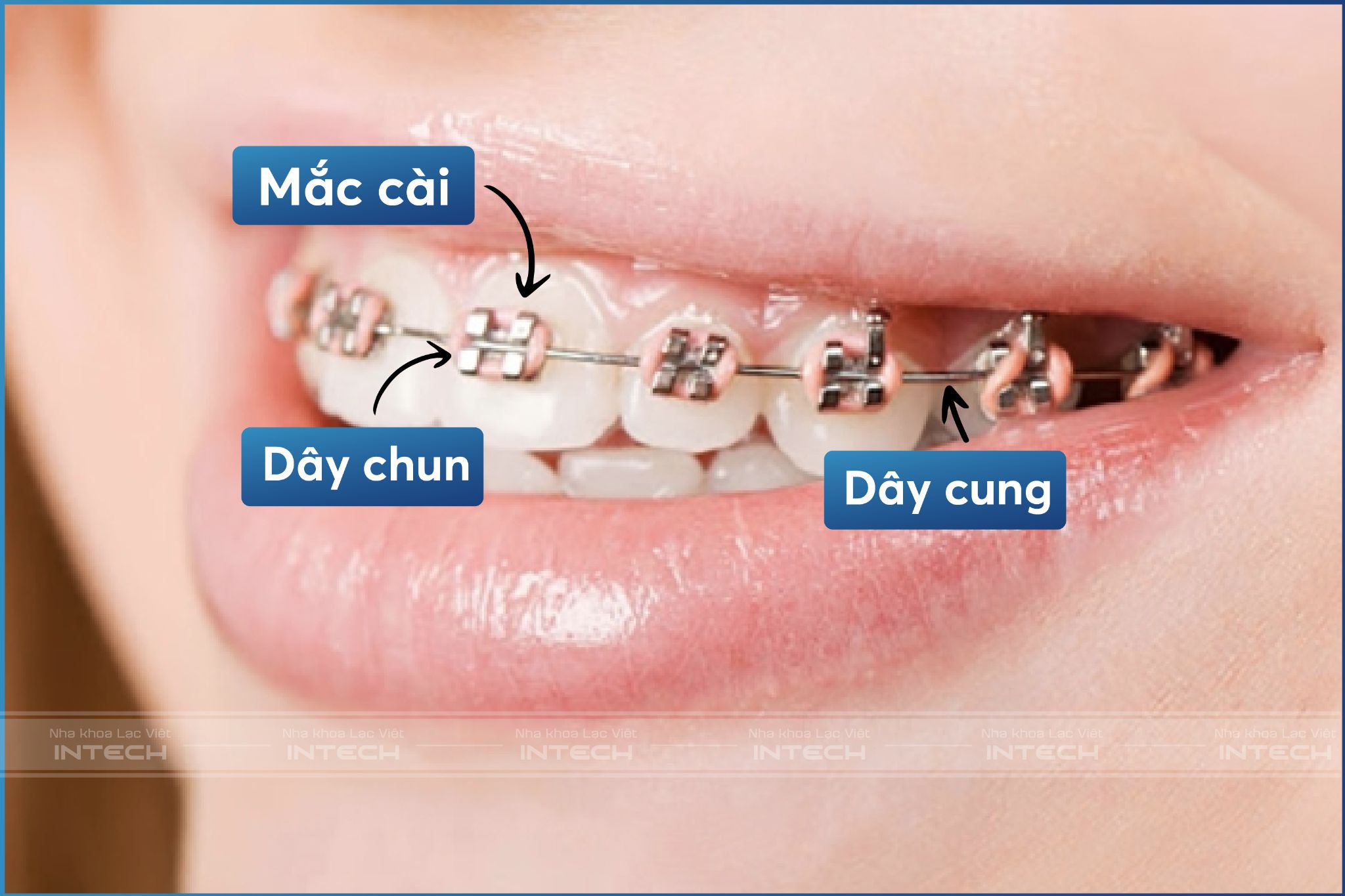 niềng răng mắc cài kim loại có tốt không