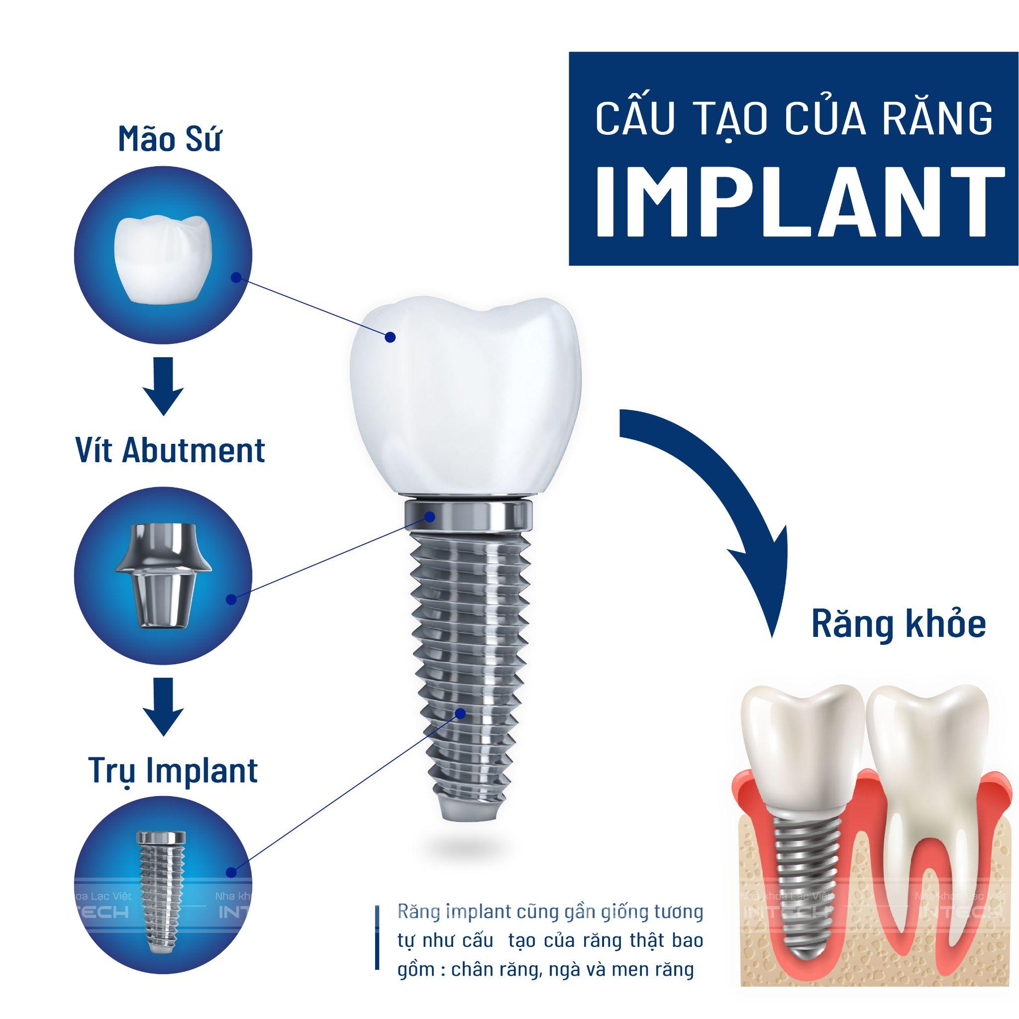 Cấu tạo răng Implant