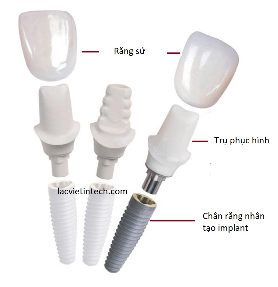 Giải pháp trồng răng implant cá nhân hóa DCT - trồng một lần, an tâm sử dụng trọn đời.