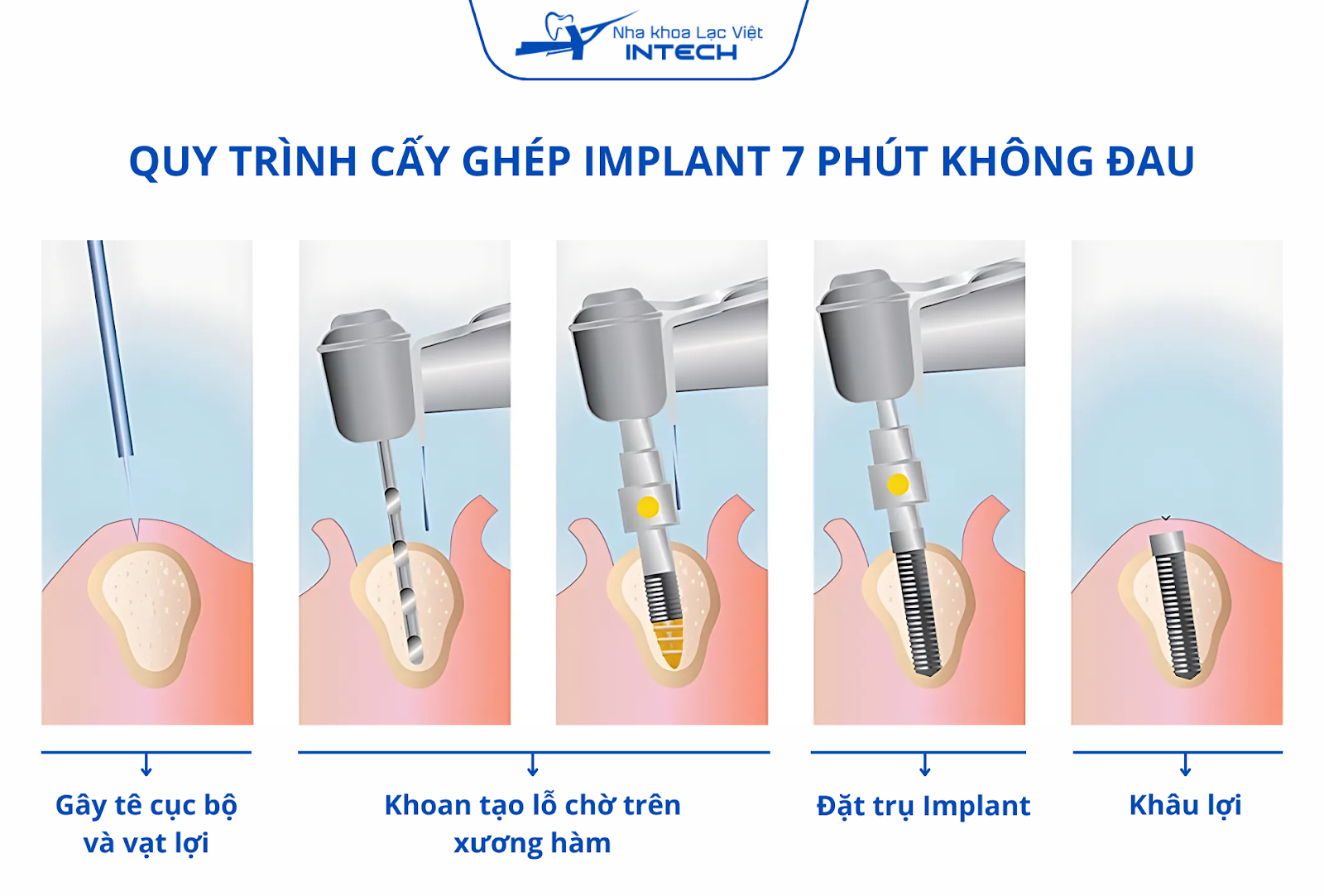 Cấy ghép Implant 7 phút không đau: Sự thật và những điều cần biết