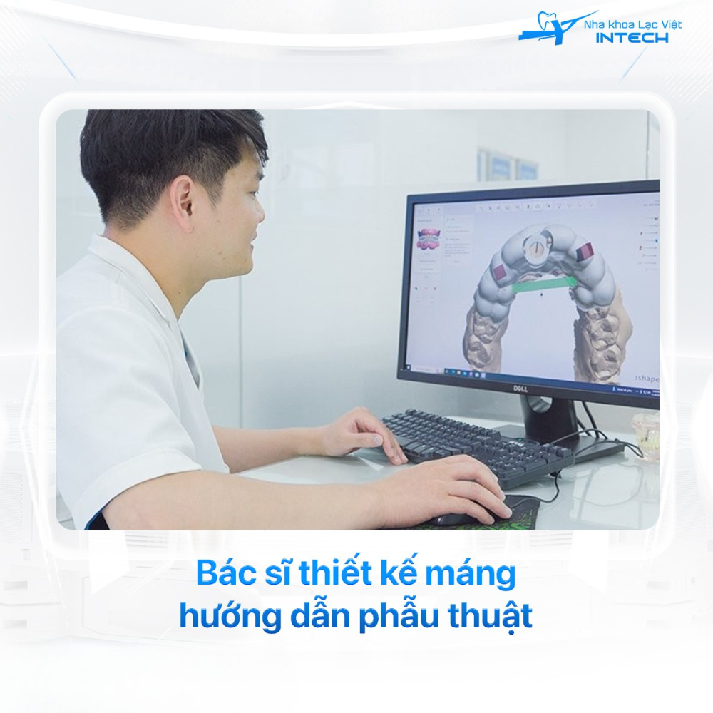 Máng hướng dẫn phẫu thuật Guideline được thiết kế theo dữ liệu xương hàm của từng người